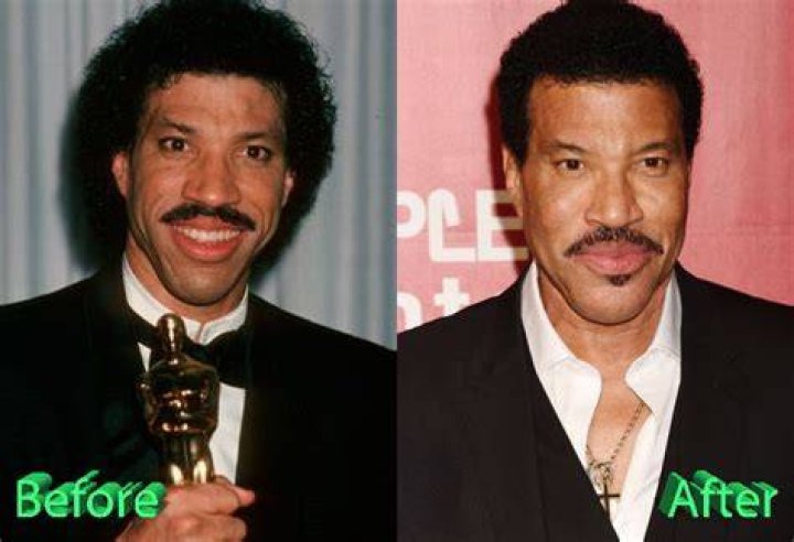lionel richie plastic surgery
